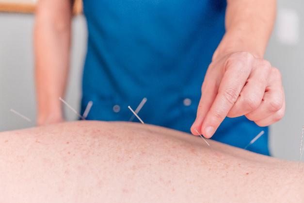 Acupuncture